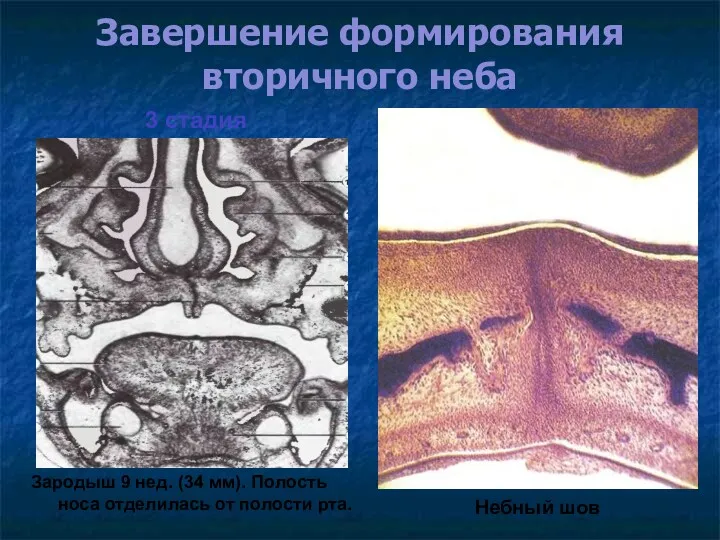 Завершение формирования вторичного неба Небный шов 3 стадия Зародыш 9