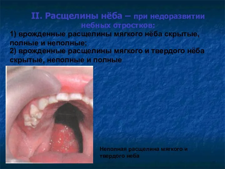 II. Расщелины нёба – при недоразвитии небных отростков: 1) врожденные