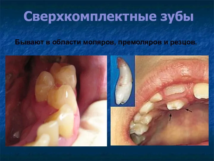 Сверхкомплектные зубы Бывают в области моляров, премоляров и резцов.