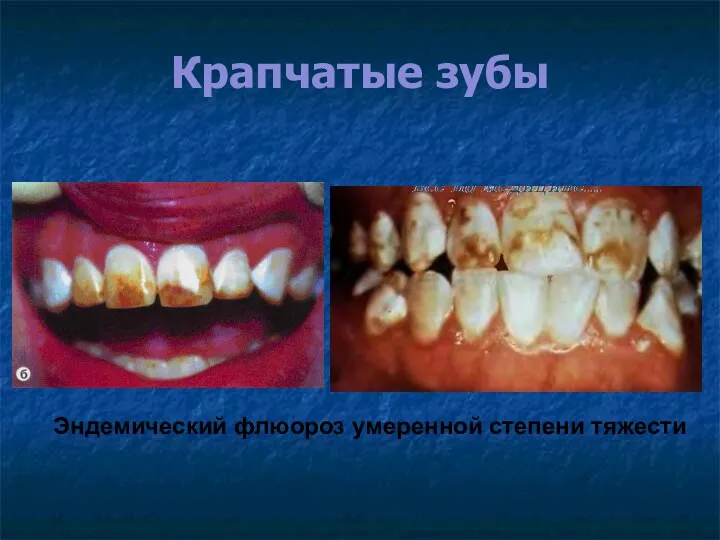 Крапчатые зубы Эндемический флюороз умеренной степени тяжести