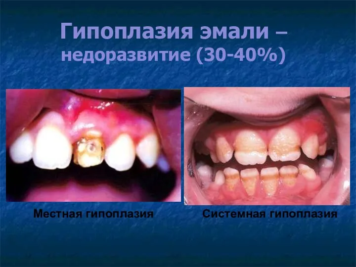 Гипоплазия эмали – недоразвитие (30-40%) Системная гипоплазия Местная гипоплазия