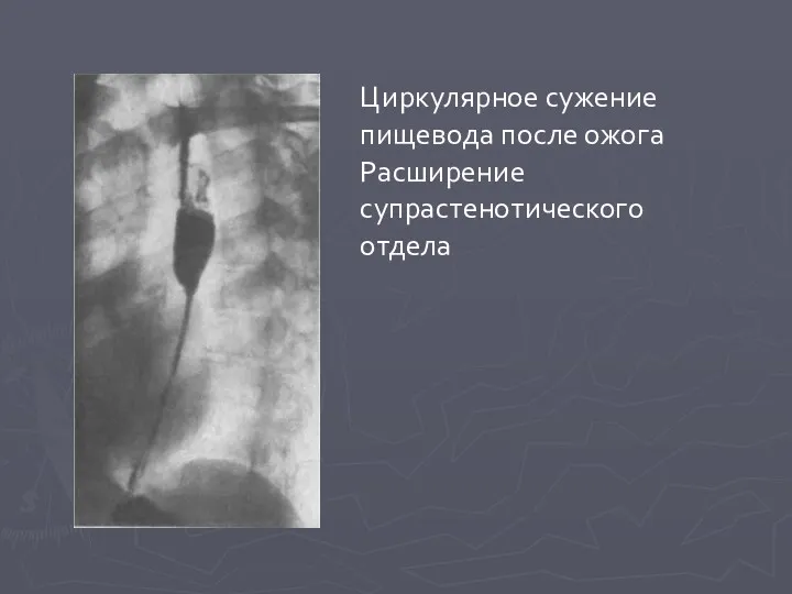 Циркулярное сужение пищевода после ожога Расширение супрастенотического отдела