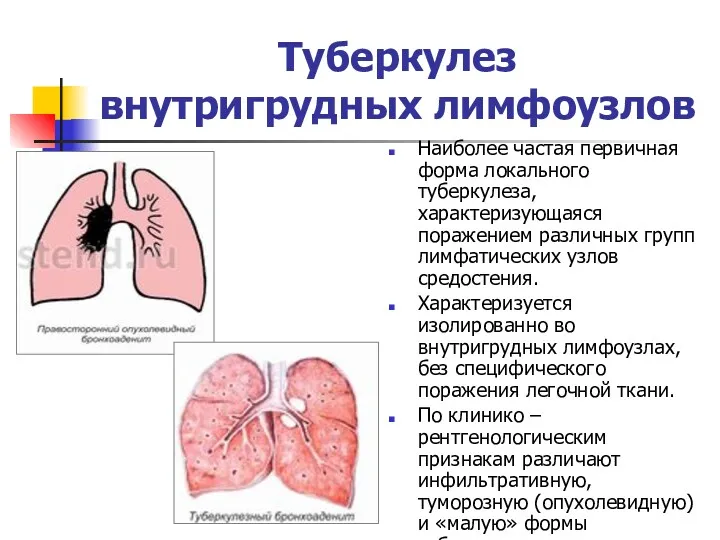 Туберкулез внутригрудных лимфоузлов Наиболее частая первичная форма локального туберкулеза, характеризующаяся поражением различных групп