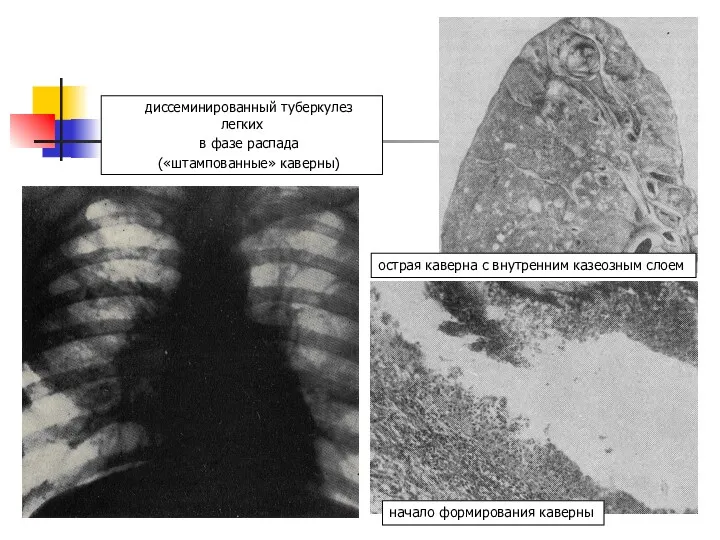 диссеминированный туберкулез легких в фазе распада («штампованные» каверны) начало формирования каверны острая каверна