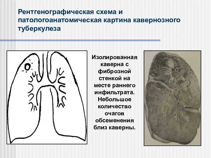 Рентгенографическая схема и патологоанатомическая картина кавернозного туберкулеза Изолированная каверна с