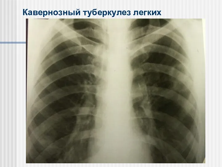Кавернозный туберкулез легких