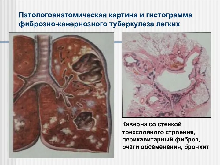 Патологоанатомическая картина и гистограмма фиброзно-кавернозного туберкулеза легких Каверна со стенкой