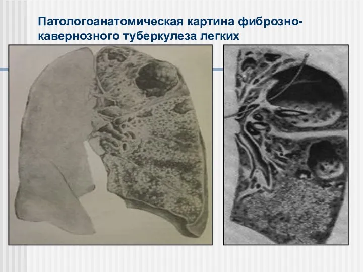 Патологоанатомическая картина фиброзно-кавернозного туберкулеза легких