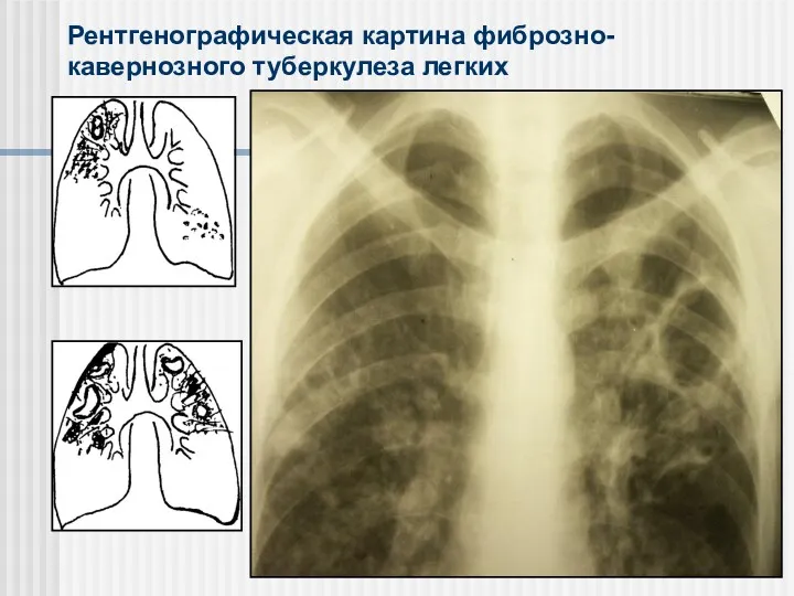Рентгенографическая картина фиброзно-кавернозного туберкулеза легких