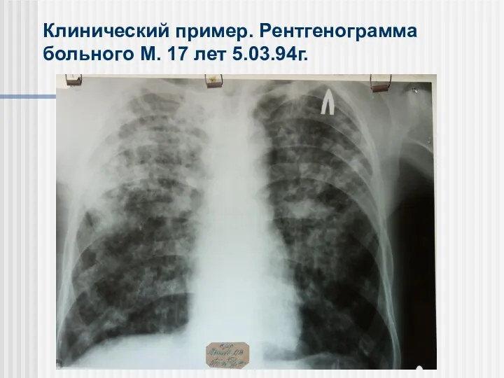 Клинический пример. Рентгенограмма больного М. 17 лет 5.03.94г.