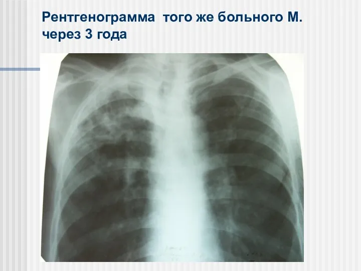 Рентгенограмма того же больного М. через 3 года