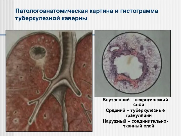 Патологоанатомическая картина и гистограмма туберкулезной каверны Внутренний – некротический слой