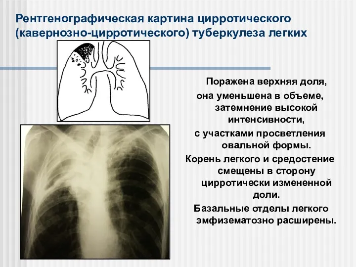 Рентгенографическая картина цирротического (кавернозно-цирротического) туберкулеза легких Поражена верхняя доля, она