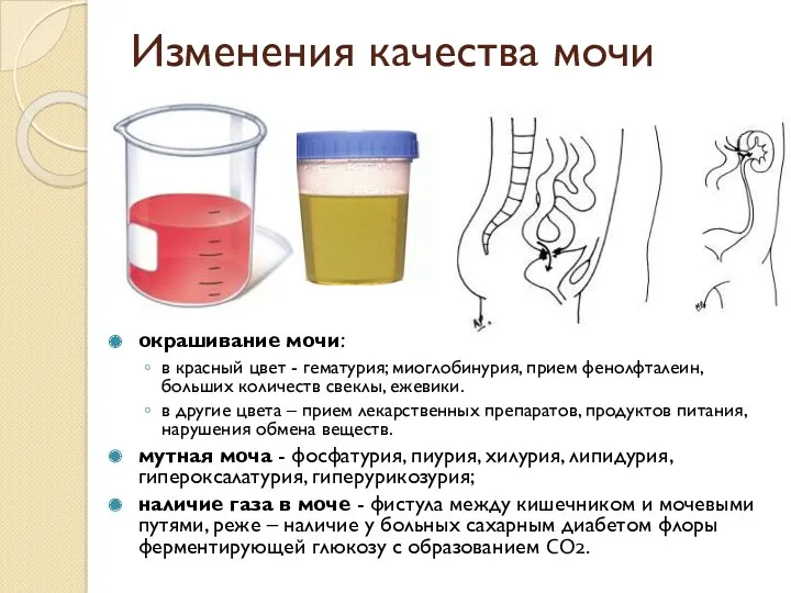 Изменения качества мочи окрашивание мочи: в красный цвет - гематурия;