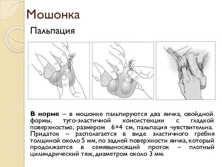 Мошонка Пальпация В норме – в мошонке пальпируются два яичка,