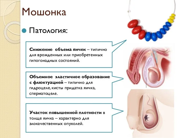 Мошонка Патология: Объемное эластичное образование с флюктуацией – типично для