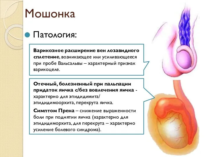 Мошонка Патология: Отечный, болезненный при пальпации придаток яичка с/без вовлечения