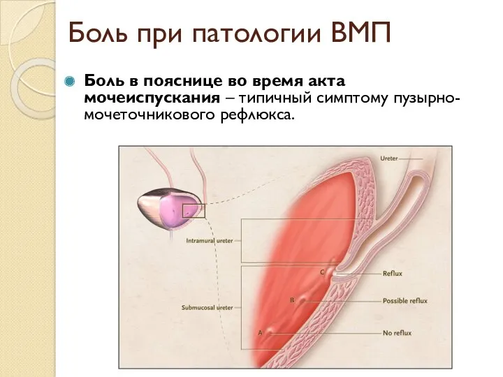 Боль при патологии ВМП Боль в пояснице во время акта мочеиспускания – типичный симптому пузырно-мочеточникового рефлюкса.
