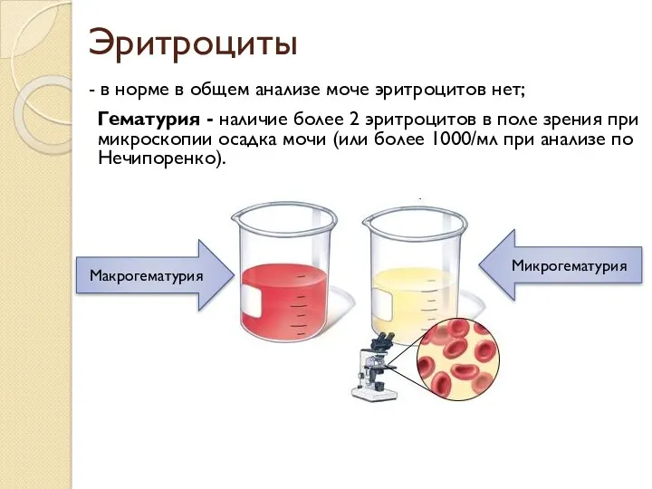 Эритроциты - в норме в общем анализе моче эритроцитов нет;