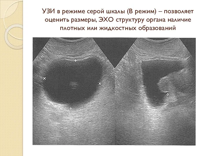 УЗИ в режиме серой шкалы (B режим) – позволяет оценить