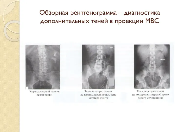 Обзорная рентгенограмма – диагностика дополнительных теней в проекции МВС