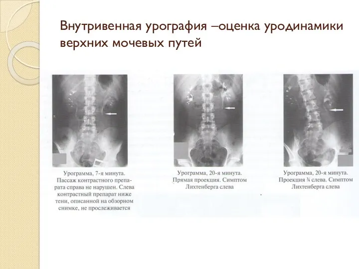 Внутривенная урография –оценка уродинамики верхних мочевых путей