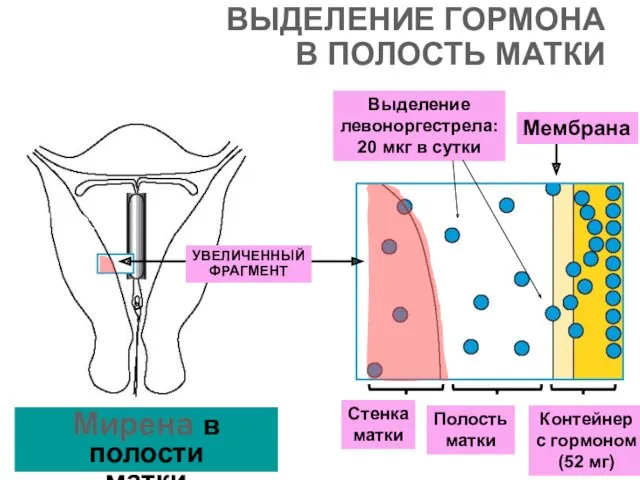 ВЫДЕЛЕНИЕ ГОРМОНА В ПОЛОСТЬ МАТКИ УВЕЛИЧЕННЫЙ ФРАГМЕНТ Мирена в полости