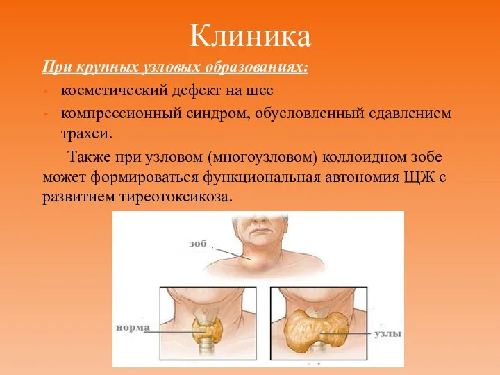 Клиника При крупных узловых образованиях: косметический дефект на шее компрессионный