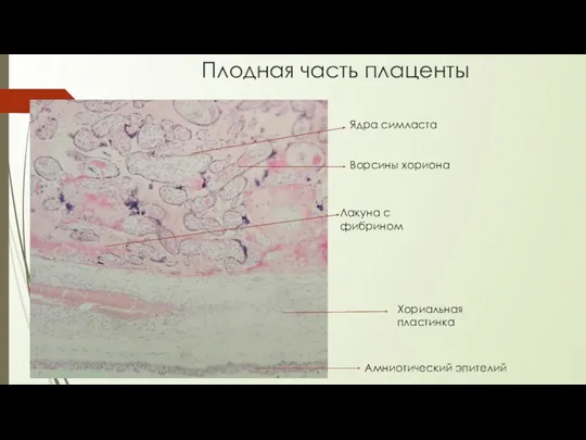 Плодная часть плаценты Лакуна с фибрином Ворсины хориона Амниотический эпителий Ядра симласта Хориальная пластинка