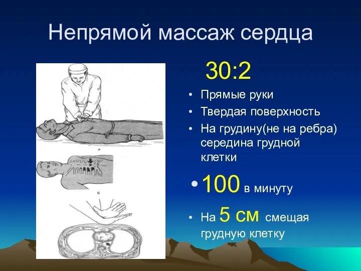 Непрямой массаж сердца 30:2 Прямые руки Твердая поверхность На грудину(не