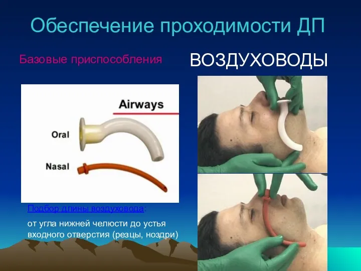 Обеспечение проходимости ДП Подбор длины воздуховода: от угла нижней челюсти