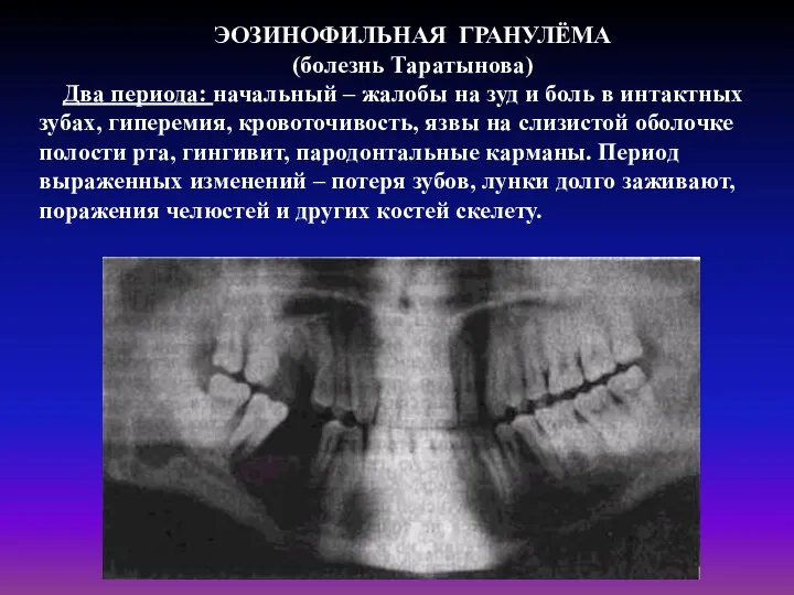 ЭОЗИНОФИЛЬНАЯ ГРАНУЛЁМА (болезнь Таратынова) Два периода: начальный – жалобы на