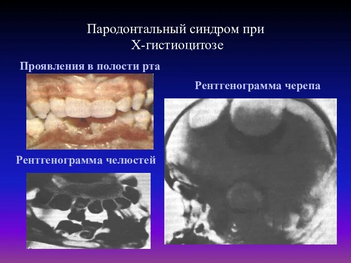 Пародонтальный синдром при Х-гистиоцитозе Проявления в полости рта Рентгенограмма челюстей Рентгенограмма черепа
