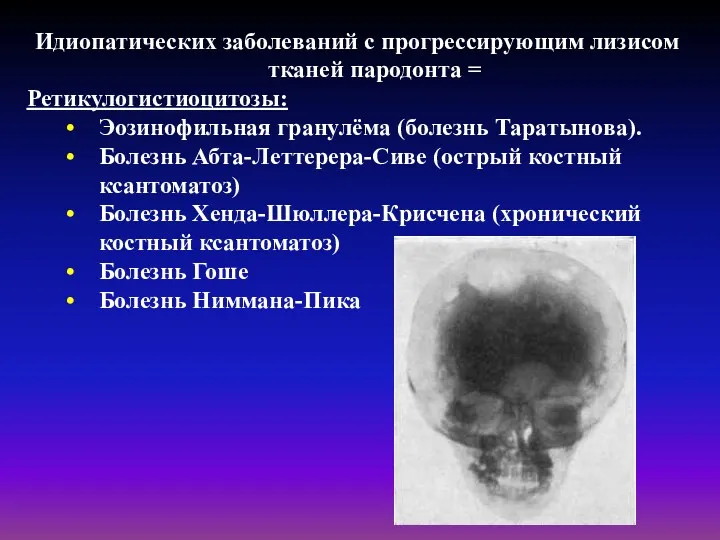 Идиопатических заболеваний с прогрессирующим лизисом тканей пародонта = Ретикулогистиоцитозы: Эозинофильная