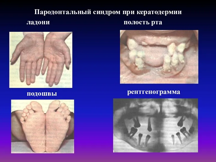 Пародонтальный синдром при кератодермии полость рта ладони подошвы рентгенограмма