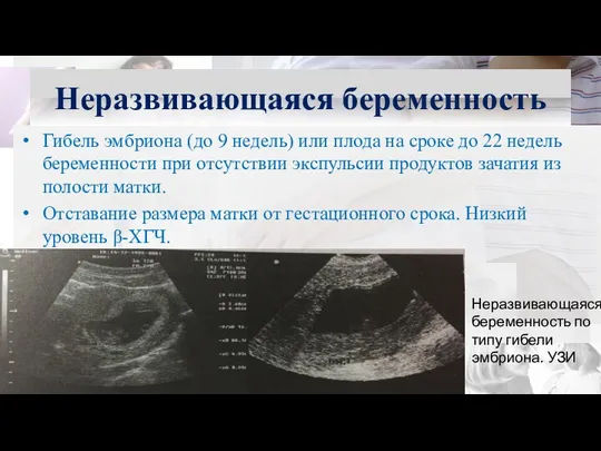 Гибель эмбриона (до 9 недель) или плода на сроке до