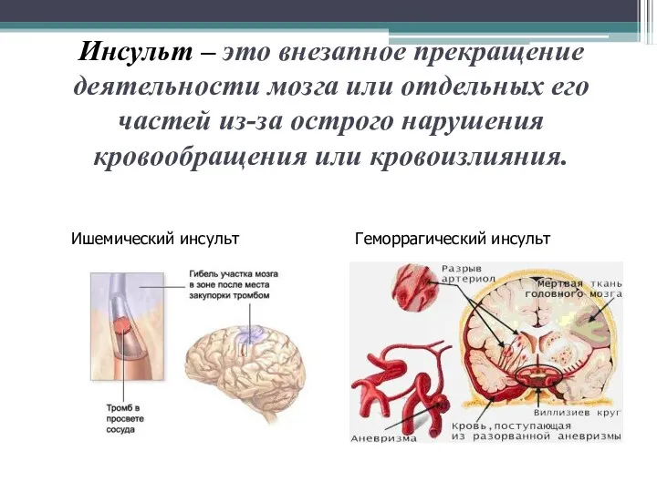 Инсульт – это внезапное прекращение деятельности мозга или отдельных его частей из-за острого