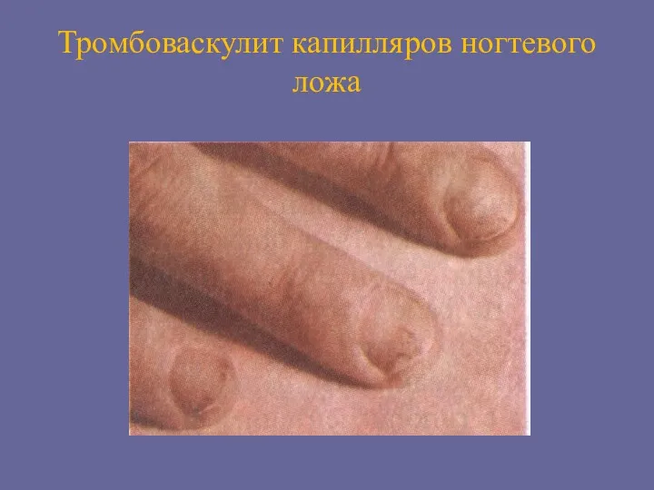 Тромбоваскулит капилляров ногтевого ложа