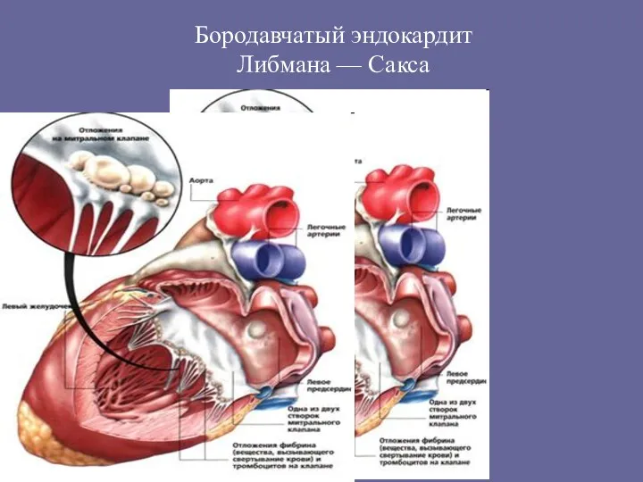 Бородавчатый эндокардит Либмана — Сакса