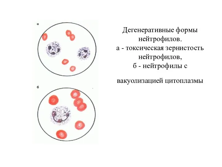 Дегенеративные формы нейтрофилов. а - токсическая зернистость нейтрофилов, б - нейтрофилы с вакуолизацией цитоплазмы