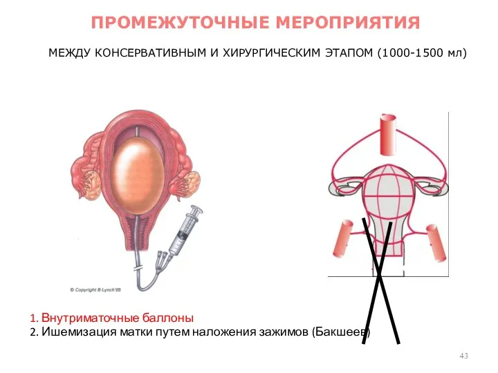 МЕЖДУ КОНСЕРВАТИВНЫМ И ХИРУРГИЧЕСКИМ ЭТАПОМ (1000-1500 мл) 1. Внутриматочные баллоны