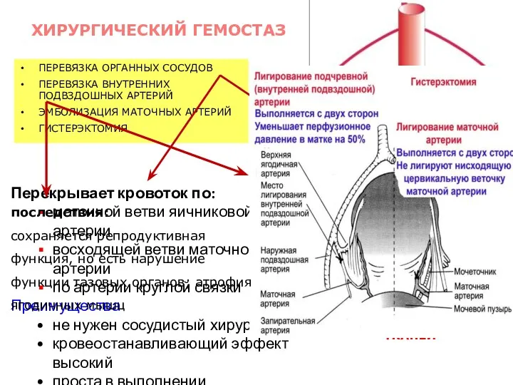 ПЕРЕВЯЗКА ОРГАННЫХ СОСУДОВ ПЕРЕВЯЗКА ВНУТРЕННИХ ПОДВЗДОШНЫХ АРТЕРИЙ ЭМБОЛИЗАЦИЯ МАТОЧНЫХ АРТЕРИЙ