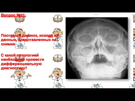 Вопрос №21: Поставьте диагноз, исходя из данных, представленных на снимке.