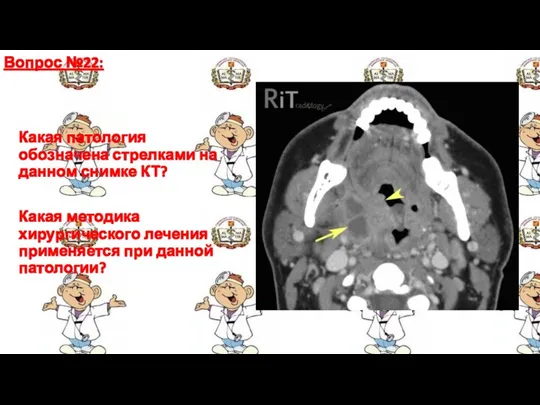 Вопрос №22: Какая патология обозначена стрелками на данном снимке КТ?