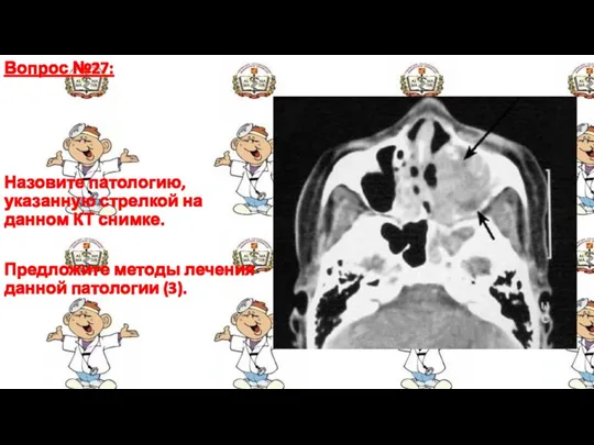 Вопрос №27: Назовите патологию, указанную стрелкой на данном КТ снимке. Предложите методы лечения данной патологии (3).