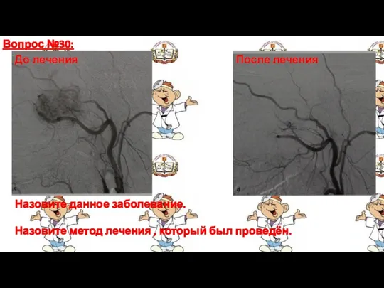 Вопрос №30: Назовите данное заболевание. Назовите метод лечения , который был проведён. До лечения После лечения