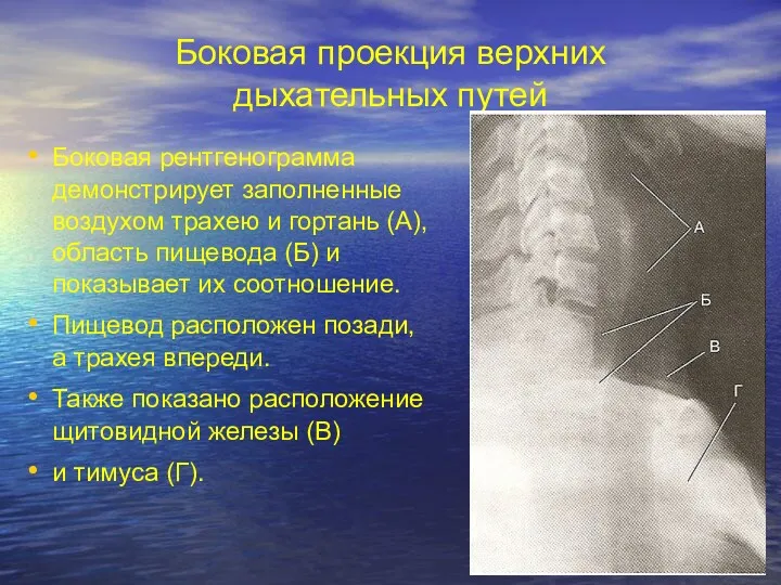 Боковая проекция верхних дыхательных путей Боковая рентгенограмма демонстрирует заполненные воздухом