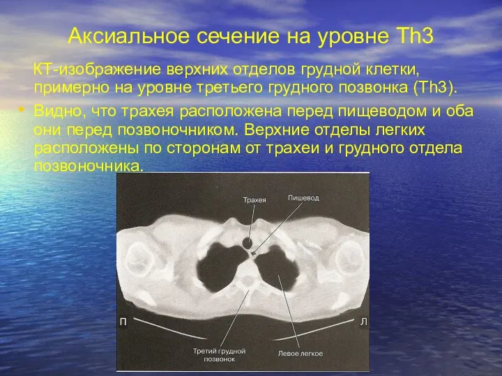 Аксиальное сечение на уровне Th3 КТ-изображение верхних отделов грудной клетки,