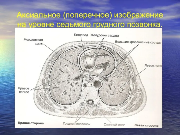 Аксиальное (поперечное) изображение на уровне седьмого грудного позвонка.