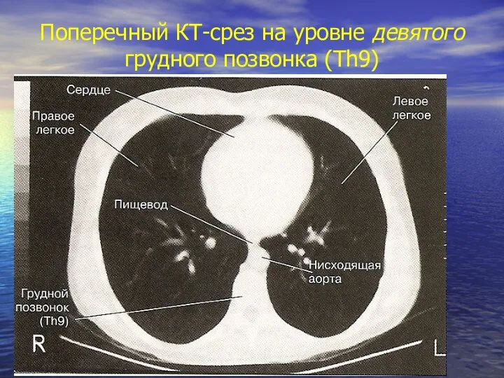 Поперечный КТ-срез на уровне девятого грудного позвонка (Th9)